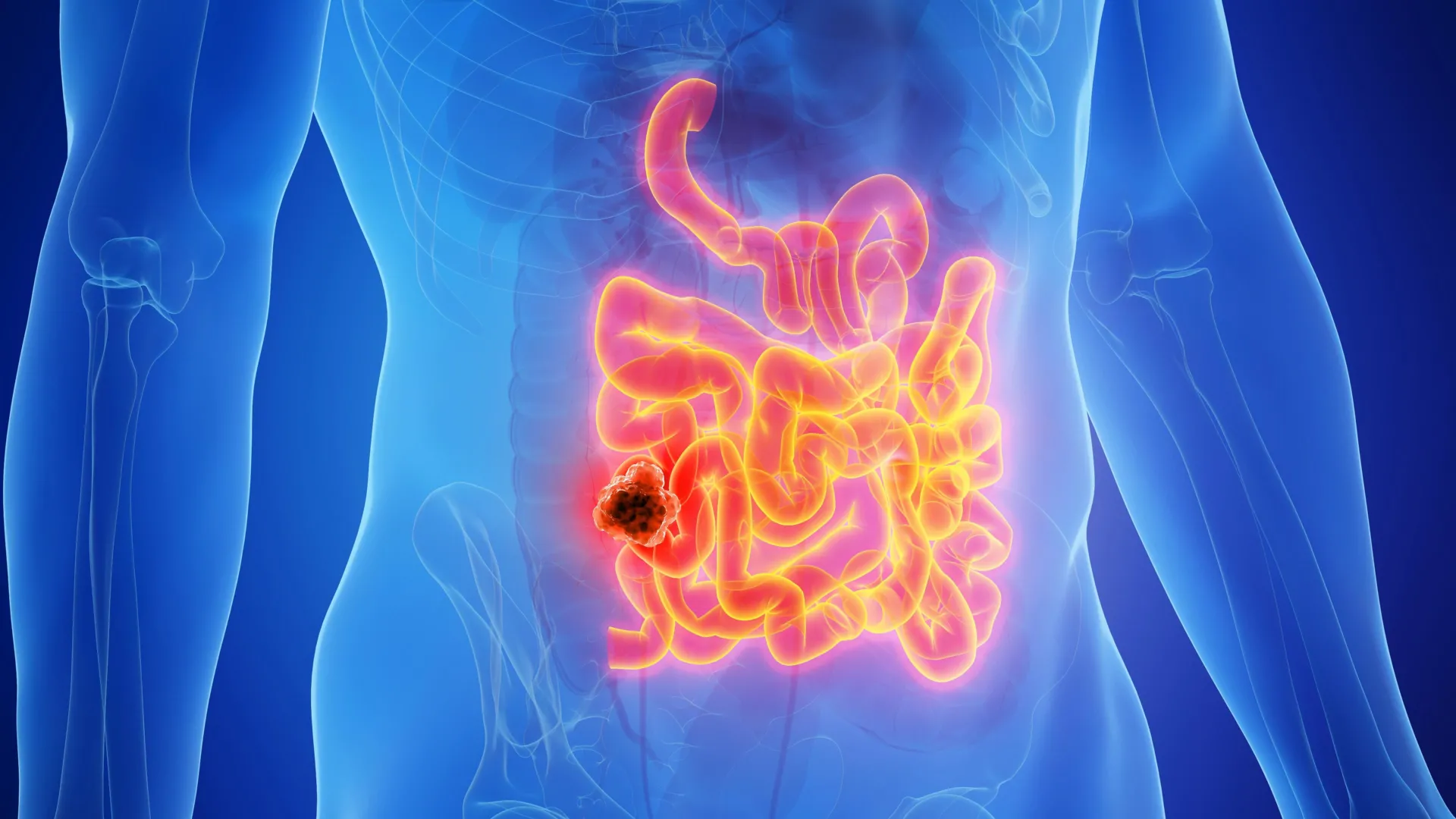 MIT scientists find a hidden cancer risk of the keto diet